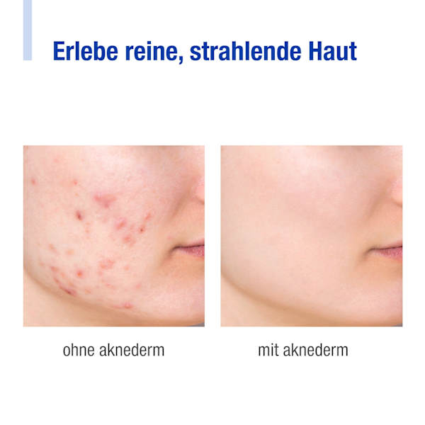 Gesichtscreme intens Aknederm