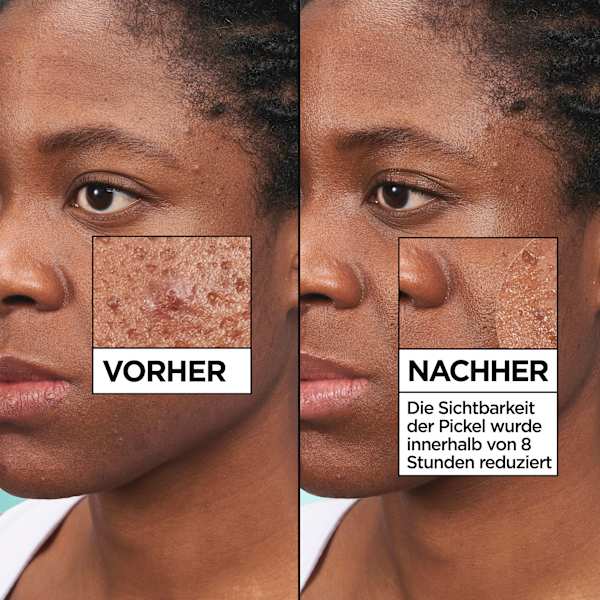 Anti Pickel Patches Invisible Garnier Skin Active