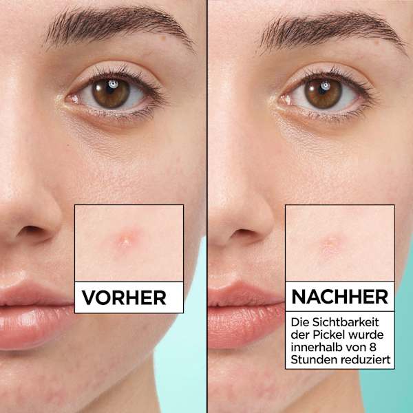 Anti Pickel Patches Invisible Garnier Skin Active