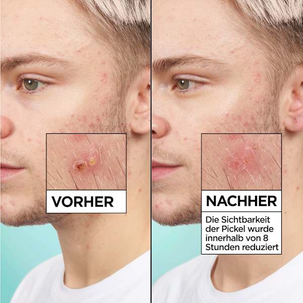 Anti Pickel Patches Invisible Garnier Skin Active
